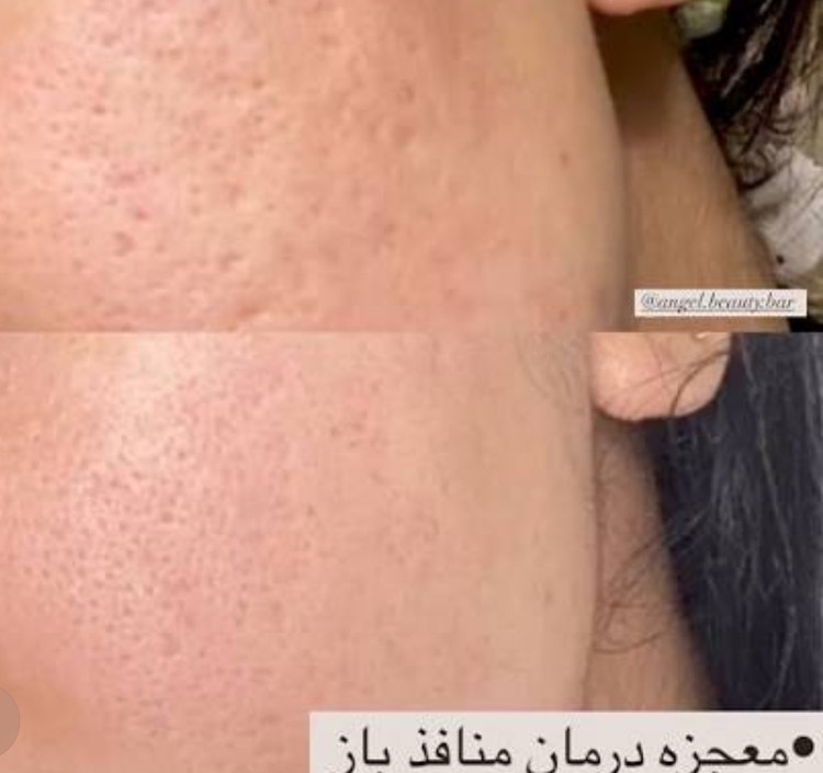 سرم بوستر جذب و بهبود بافت پوست ریدل شات ۱۰۰ | VT Reedle Shot 100