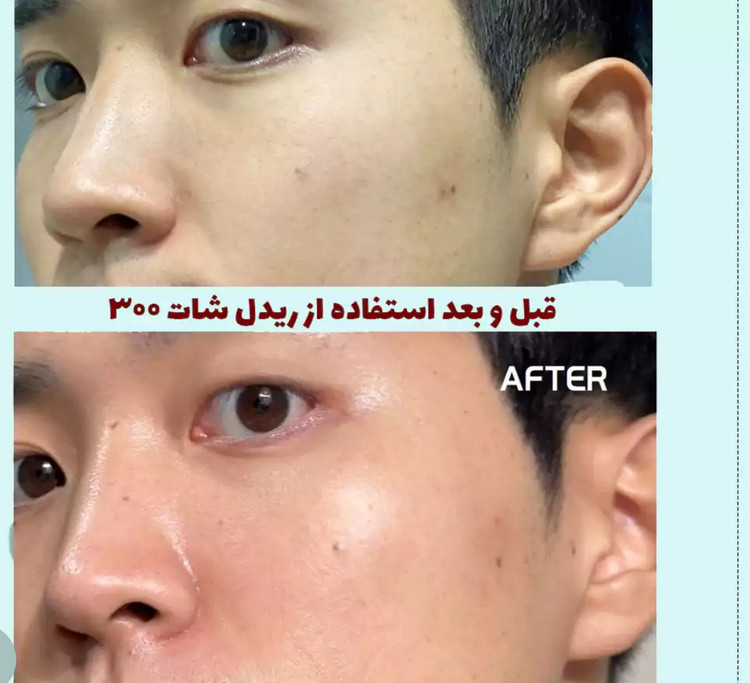 سرم بوستر جذب و بهبود بافت پوست ریدل شات ۱۰۰ | VT Reedle Shot 100