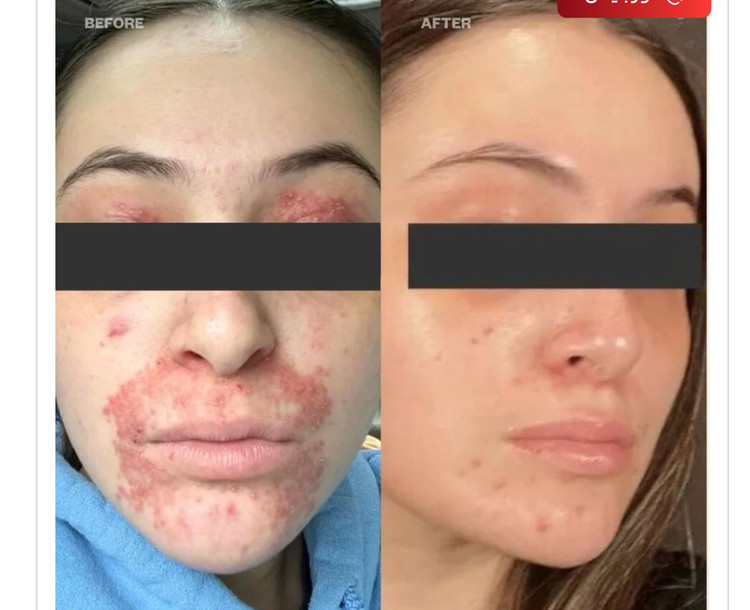 سرم آزلائیک اسید 16% مدیکیوب | Medicube Azelaic Acid 16 Calming Serum